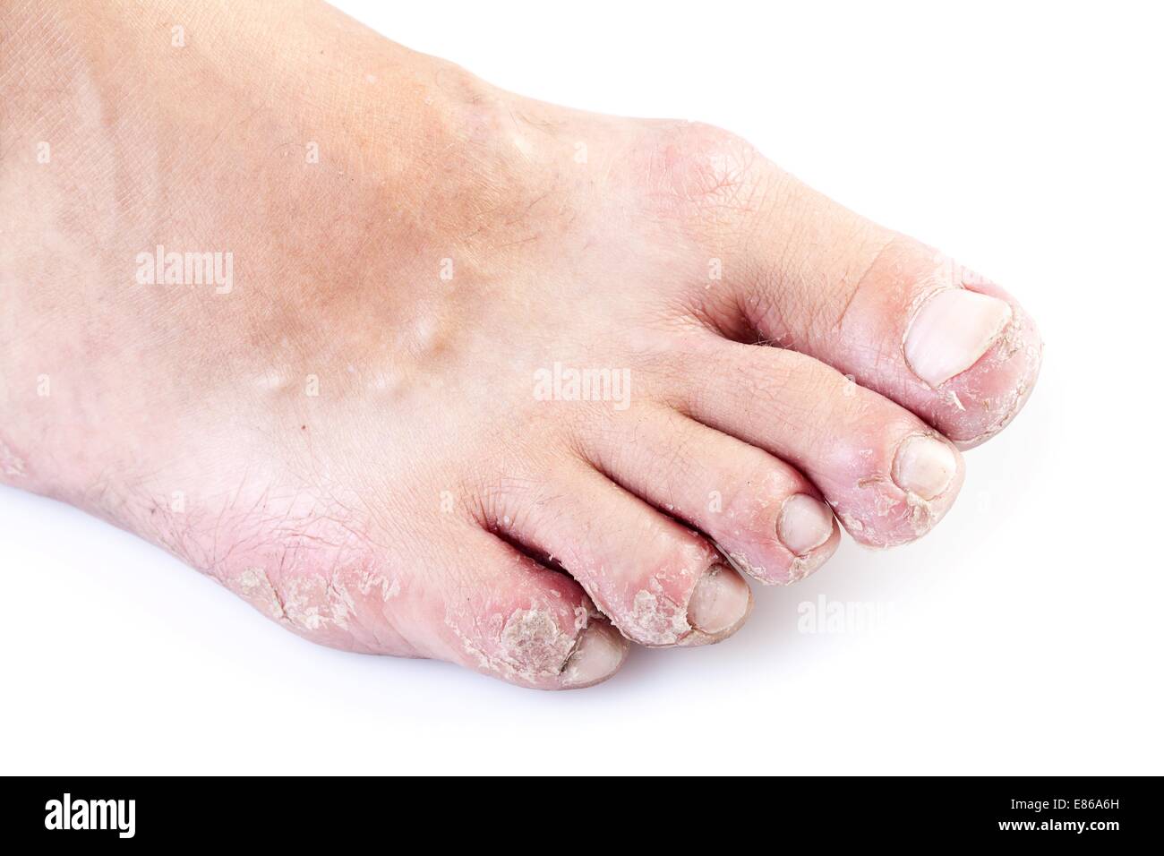 Homme célibataire pied d'eczéma isolé sur fond blanc Banque D'Images