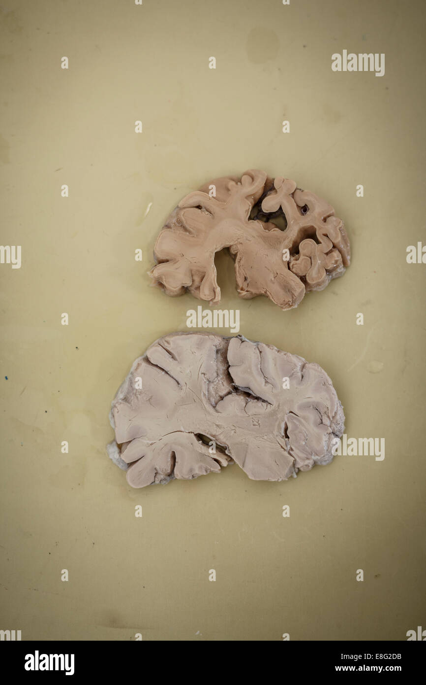 Cerveau humain pour disséquer la démence test médical Banque D'Images