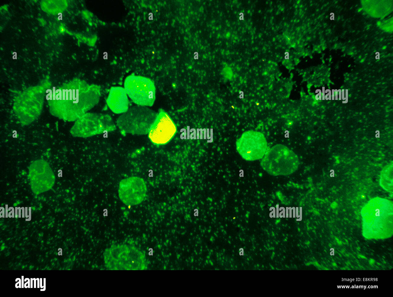 Nous voyons ici Mycobacterium tuberculosis dans un frottis est coloré en utilisant l'acide fluorescent-tache rapide M La tuberculose est une Banque D'Images