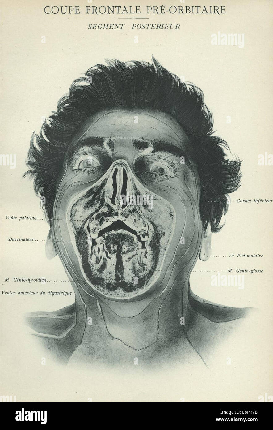 Illustration médicale tirée de l'« Atlas d'anatomie topographique » d'Eugene-Louis Doyen, montrant une vue frontale du visage d'un homme avec des caractéristiques anatomiques étiquetées. Cet atlas, publié au début du XXe siècle, représente une avancée majeure dans l’illustration médicale. Banque D'Images