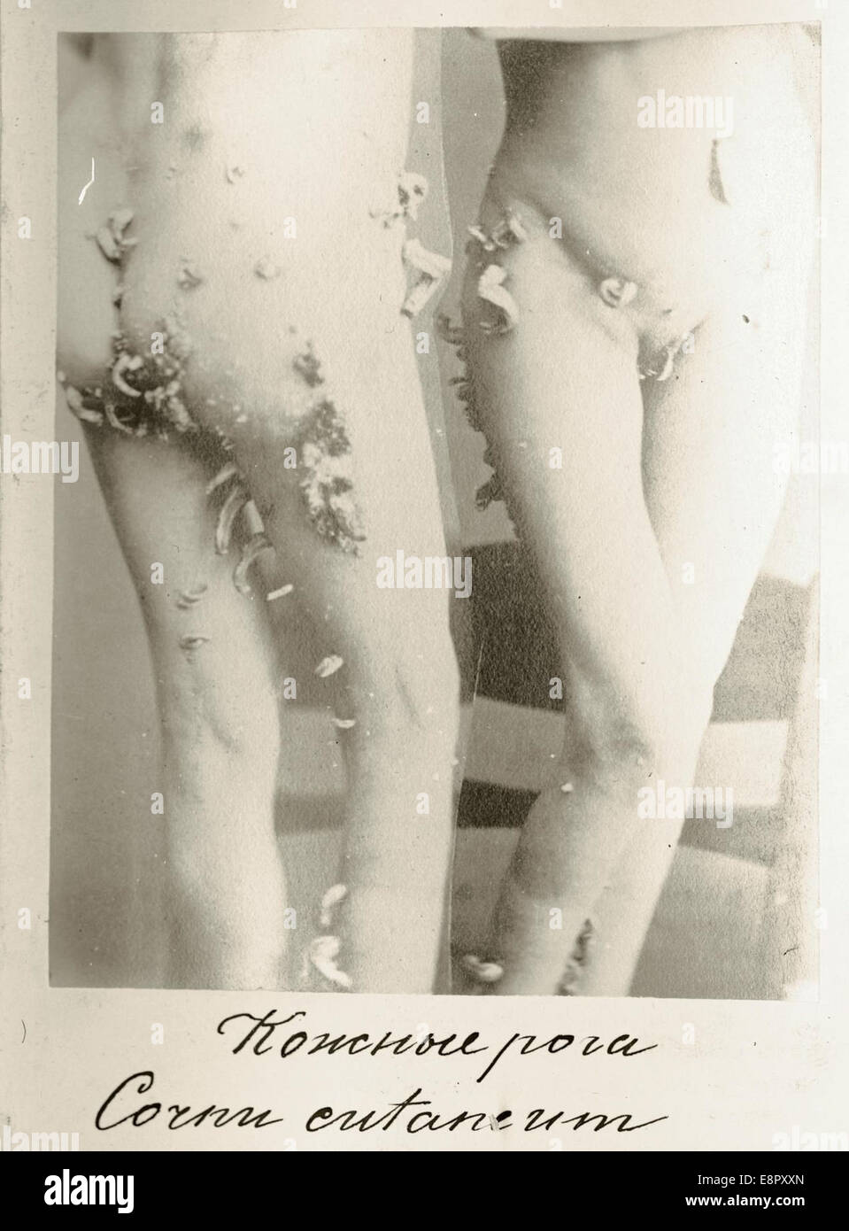 Apparaît dans : Mansurov, N. (Nikolaĭ Porfirʹevich), 1834-1892. Klinicheskiĭ dermatologīi po sbornik. L'image Description : Photographe Banque D'Images