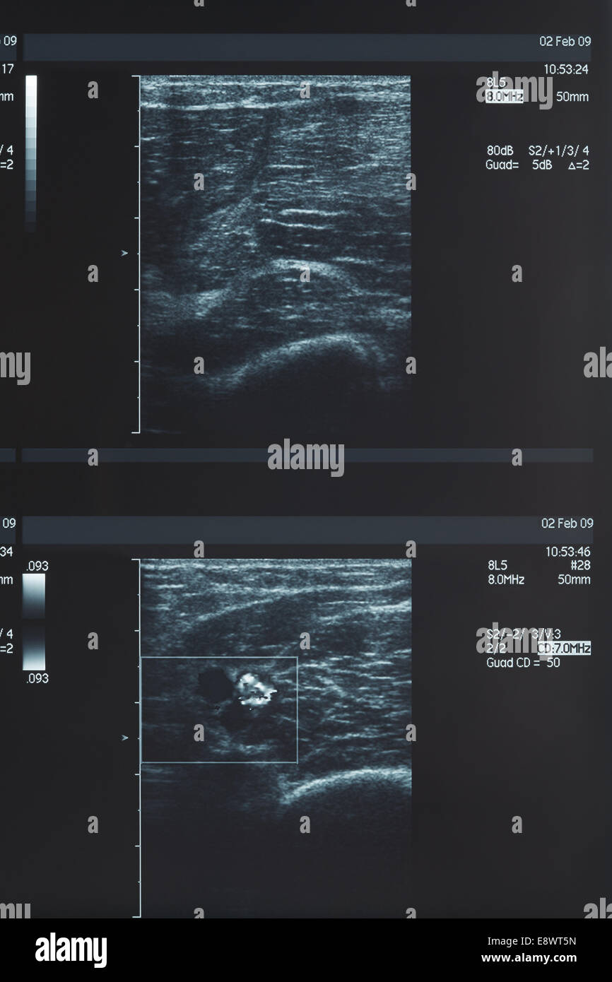 X-ray, échographie musculaire Banque D'Images