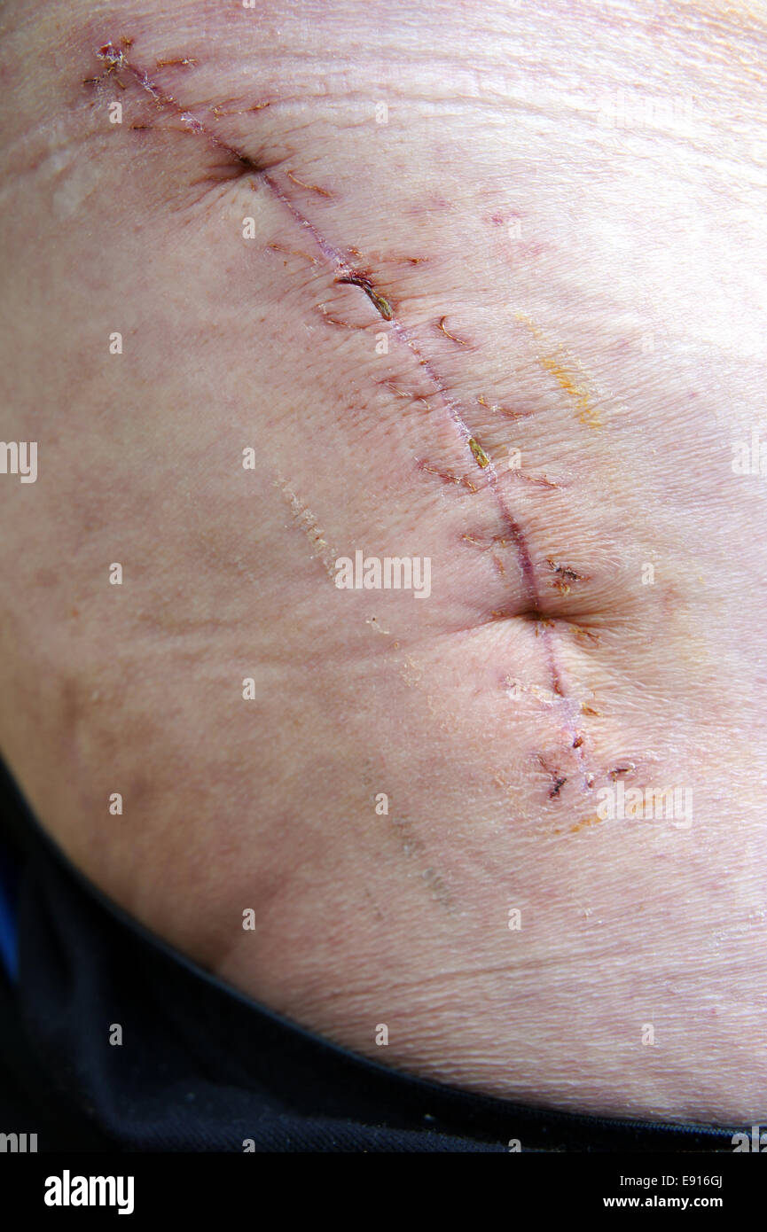Après une chirurgie cicatrice Banque D'Images