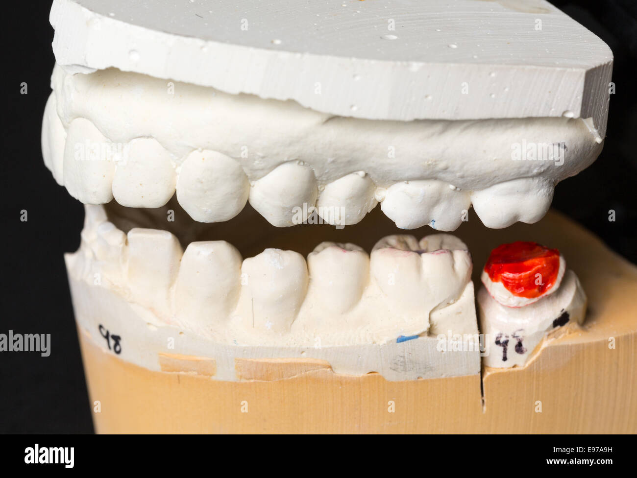 Moule de dents prises pour l'orthodontie Banque D'Images