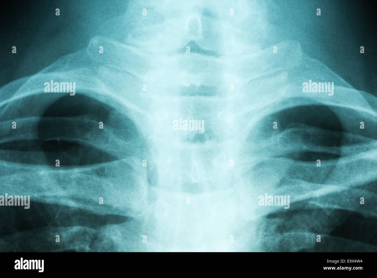 Medical X-Ray de colonne vertébrale thoracique Banque D'Images