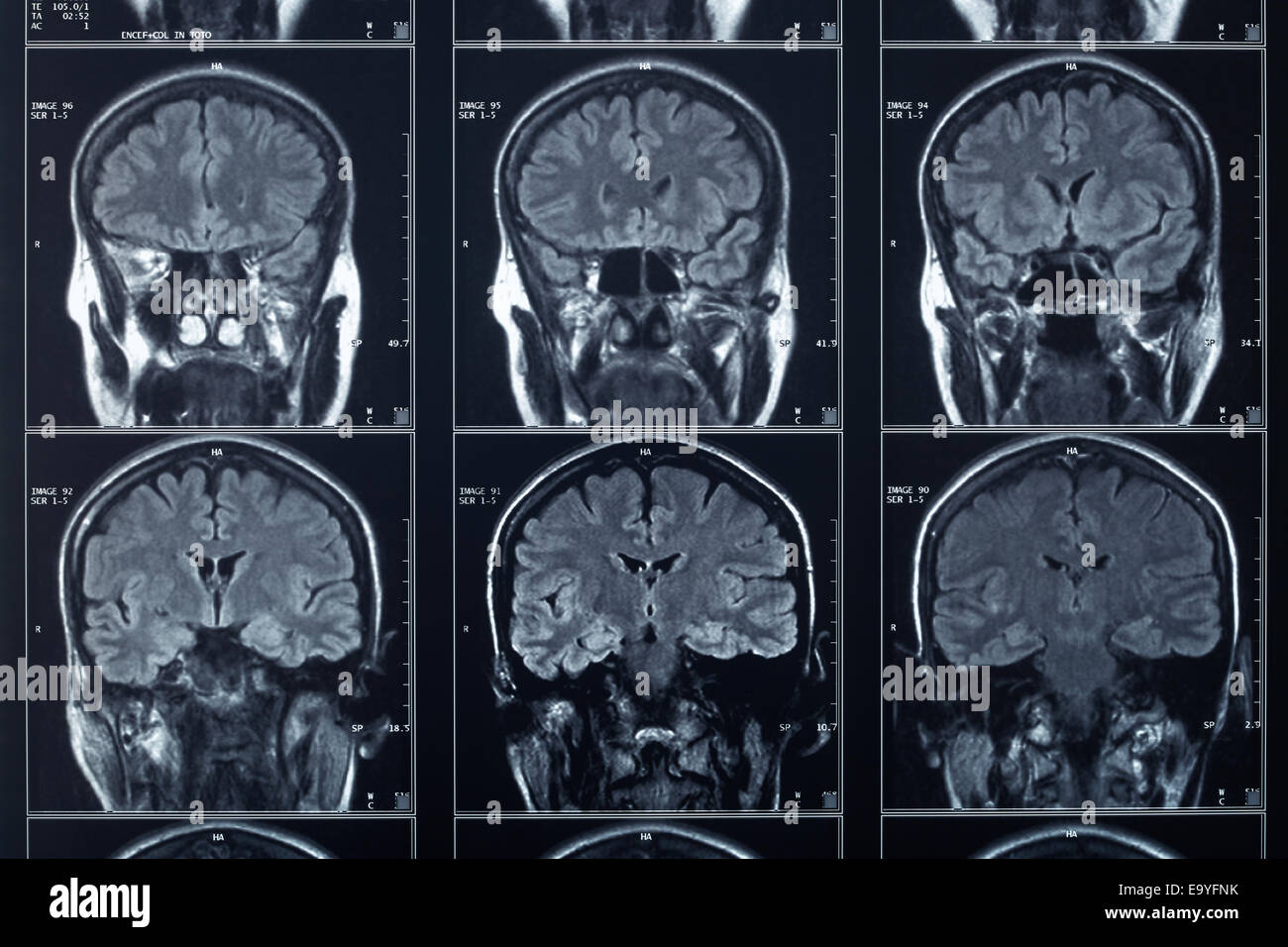Tête à rayons X et radiographie du cerveau Banque D'Images