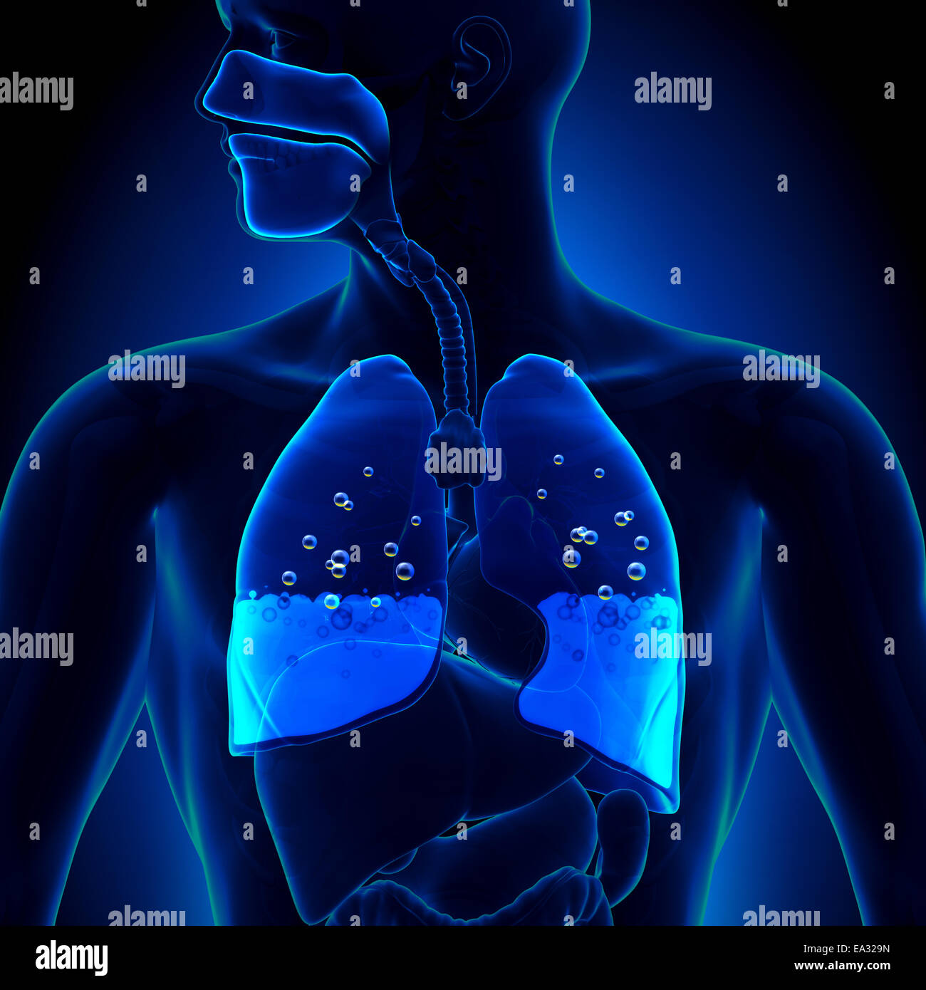 Œdème pulmonaire - l'eau dans les poumons Banque D'Images