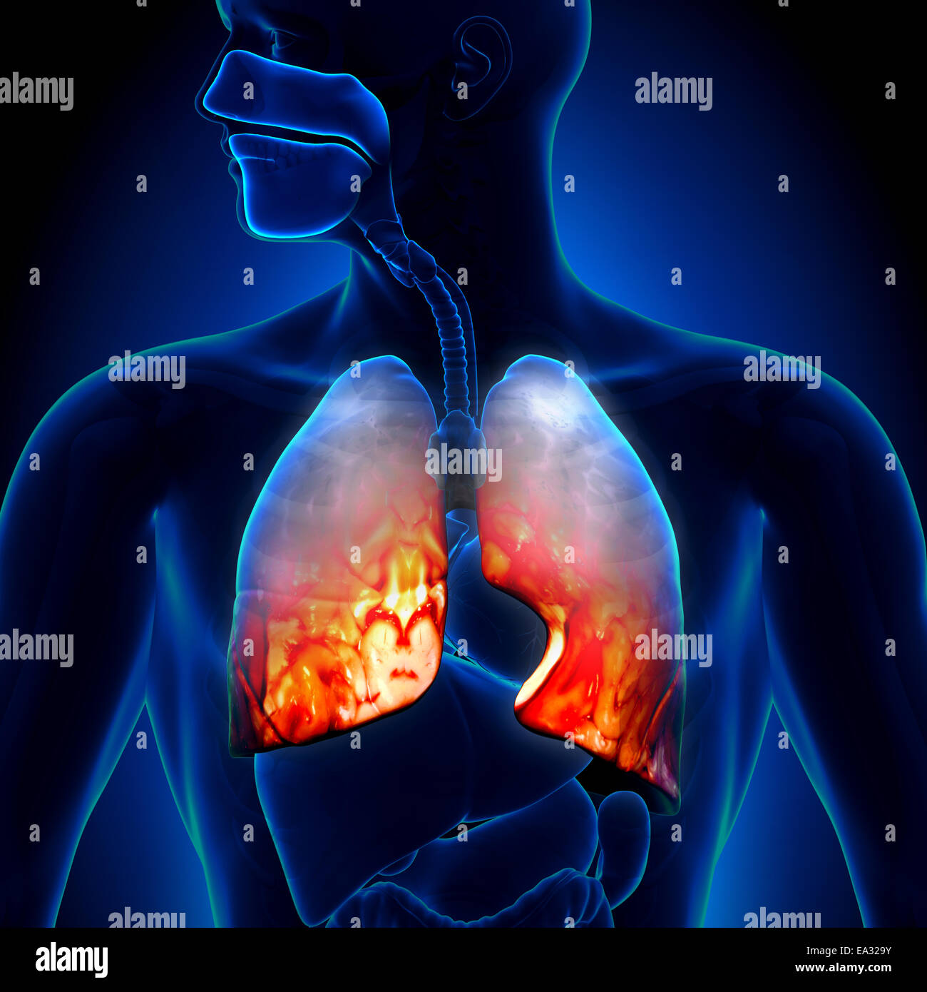 - Pneumonie Inflammation des poumons Banque D'Images