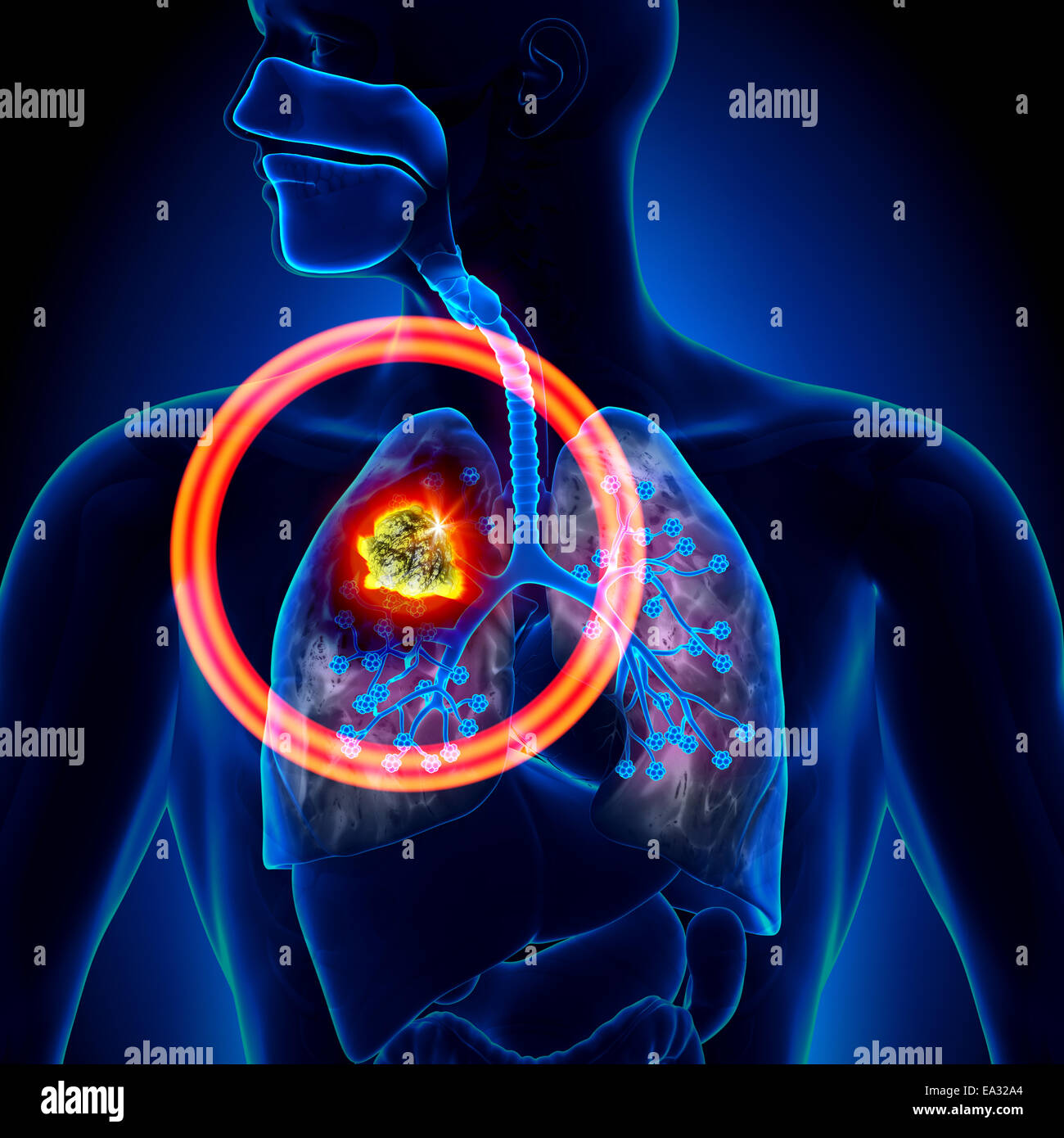 Cancer du poumon - Détail de la tumeur Banque D'Images