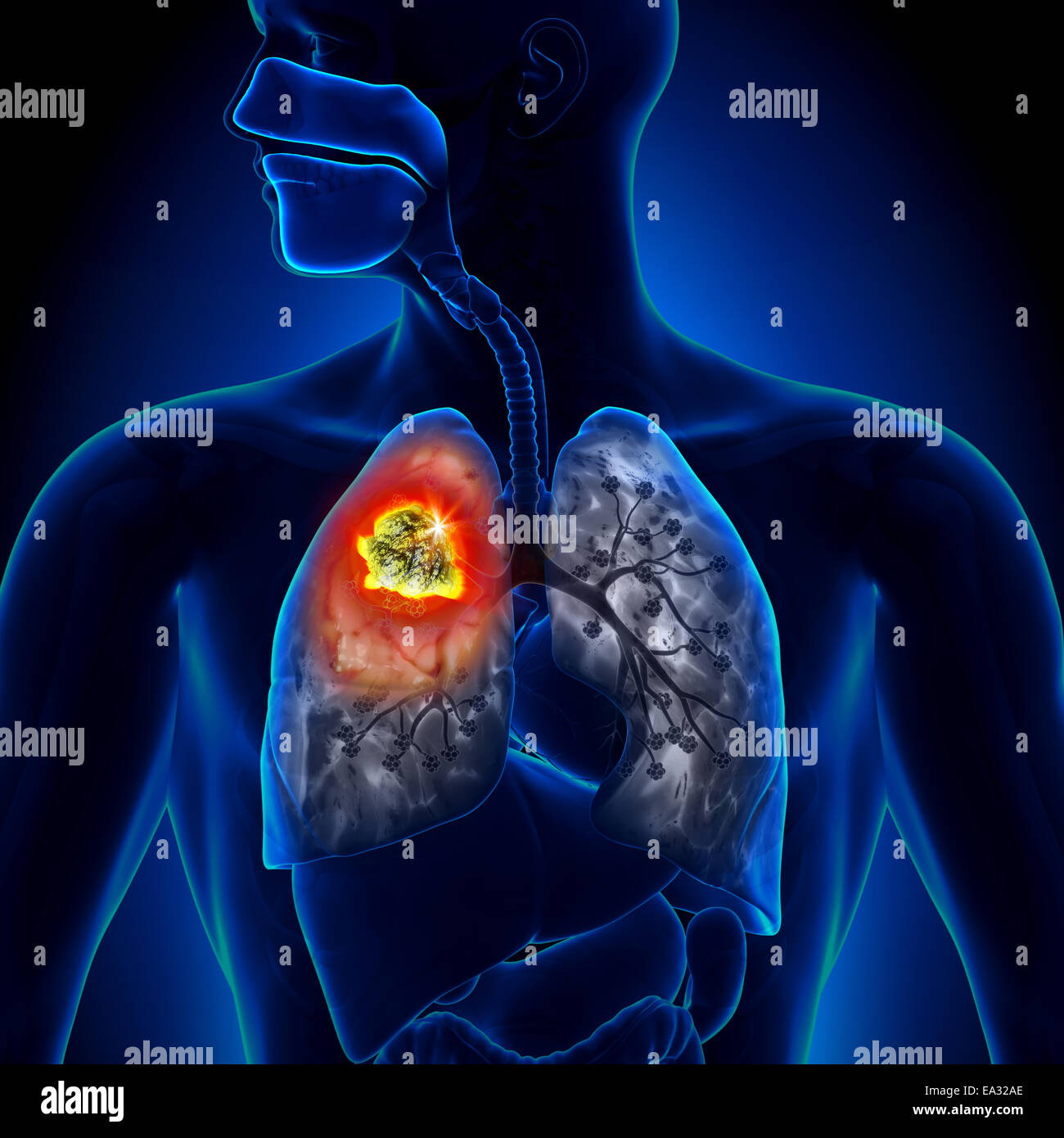 Cancer du poumon - Détail de la tumeur Banque D'Images