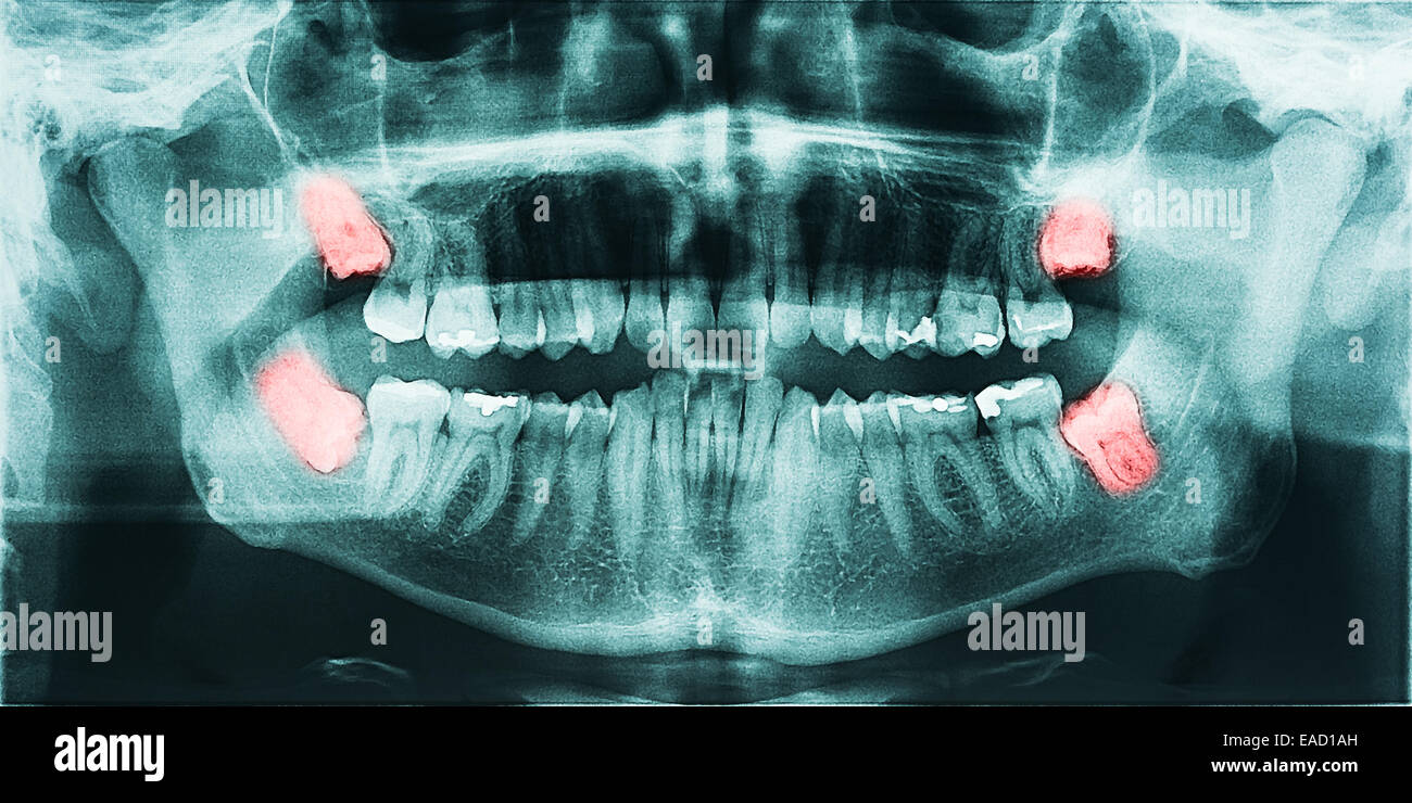 La douleur de plus en plus de dents de sagesse sur X-Ray Banque D'Images