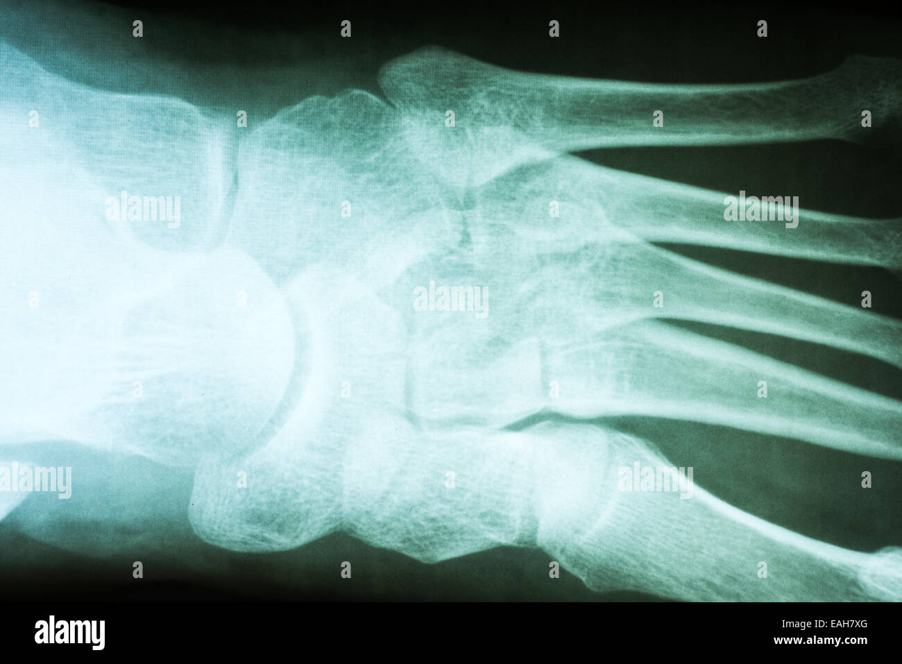 Pied humain X-Ray sur fond noir Banque D'Images