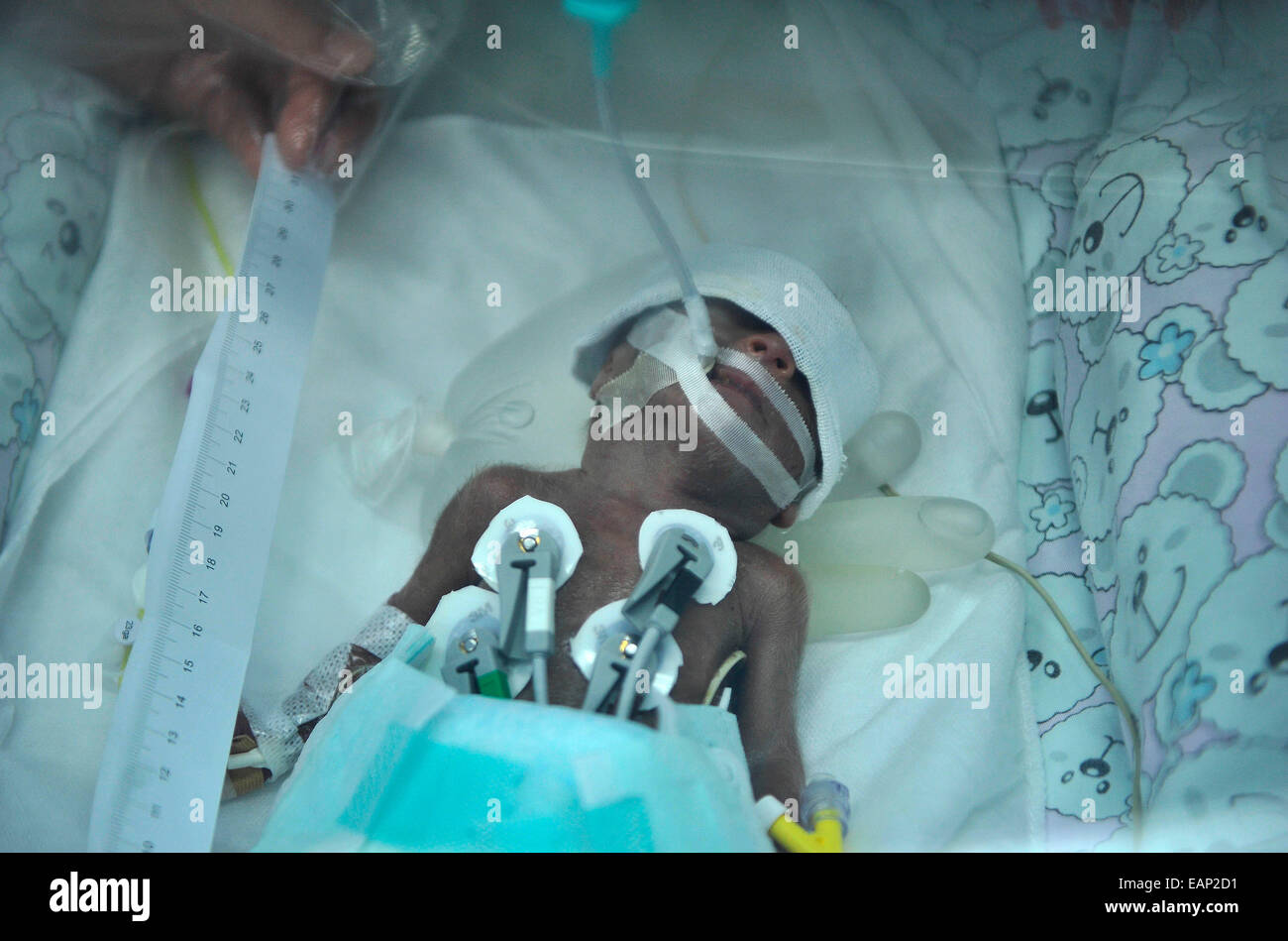 Un Poids De 660 Grammes A La Naissance Prematuree De Bebe Qui A Ete Force A Abandonner Les 23 Semaines Ont Survecu A Chongqing Sichuan Chine Le 18 Novembre 14 La Raison Un Poids De 660 Grammes A La Naissance Prematuree De Bebe Qui A Ete Force A Abandonner Les 23 Semaines Ont Survecu A Chongqing Sichuan Chine Le 18 Novembre 14 La Raison
