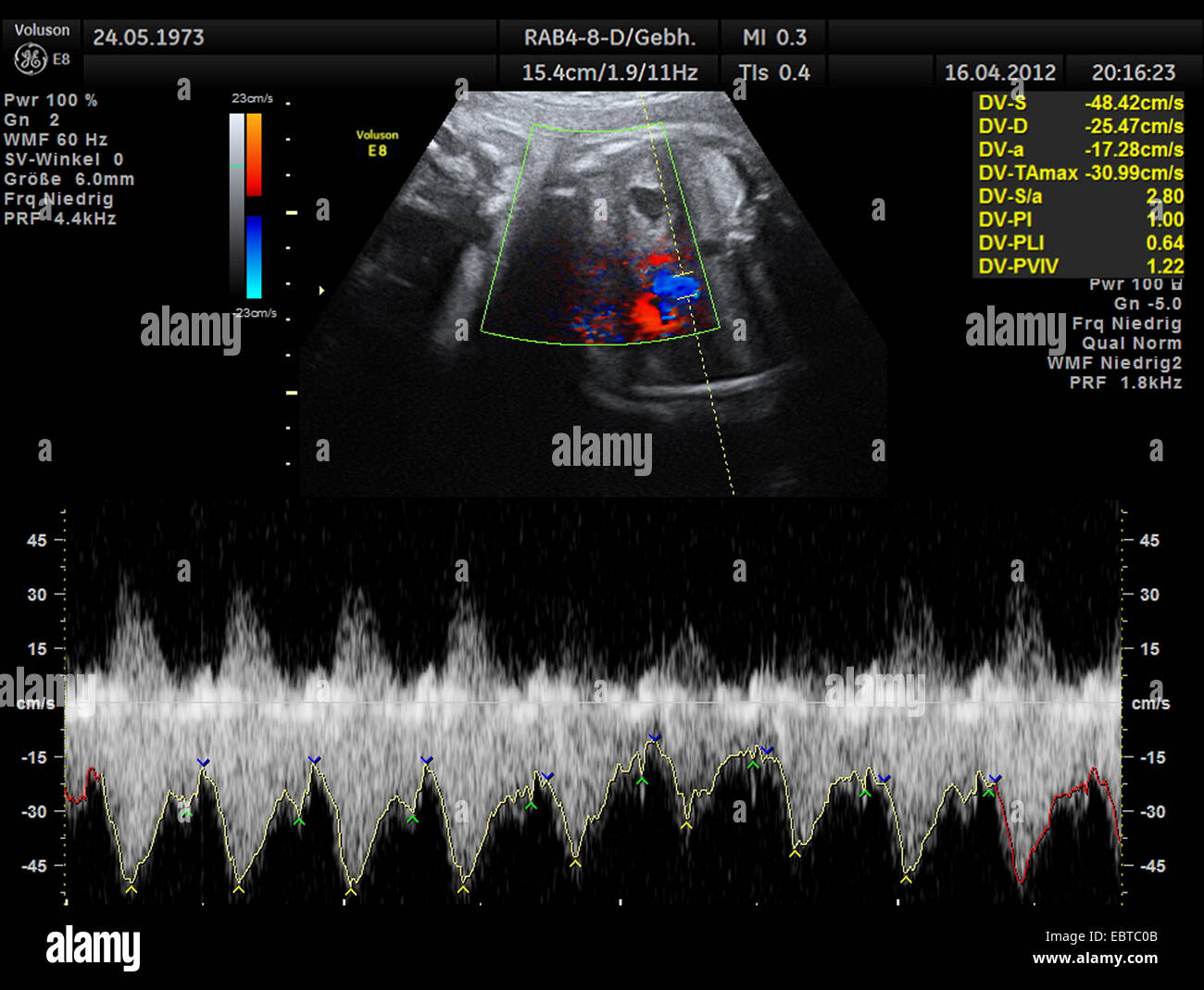 Sonogramme de l'embryon dans l'utérus avec schéma de ton coeur Banque D'Images