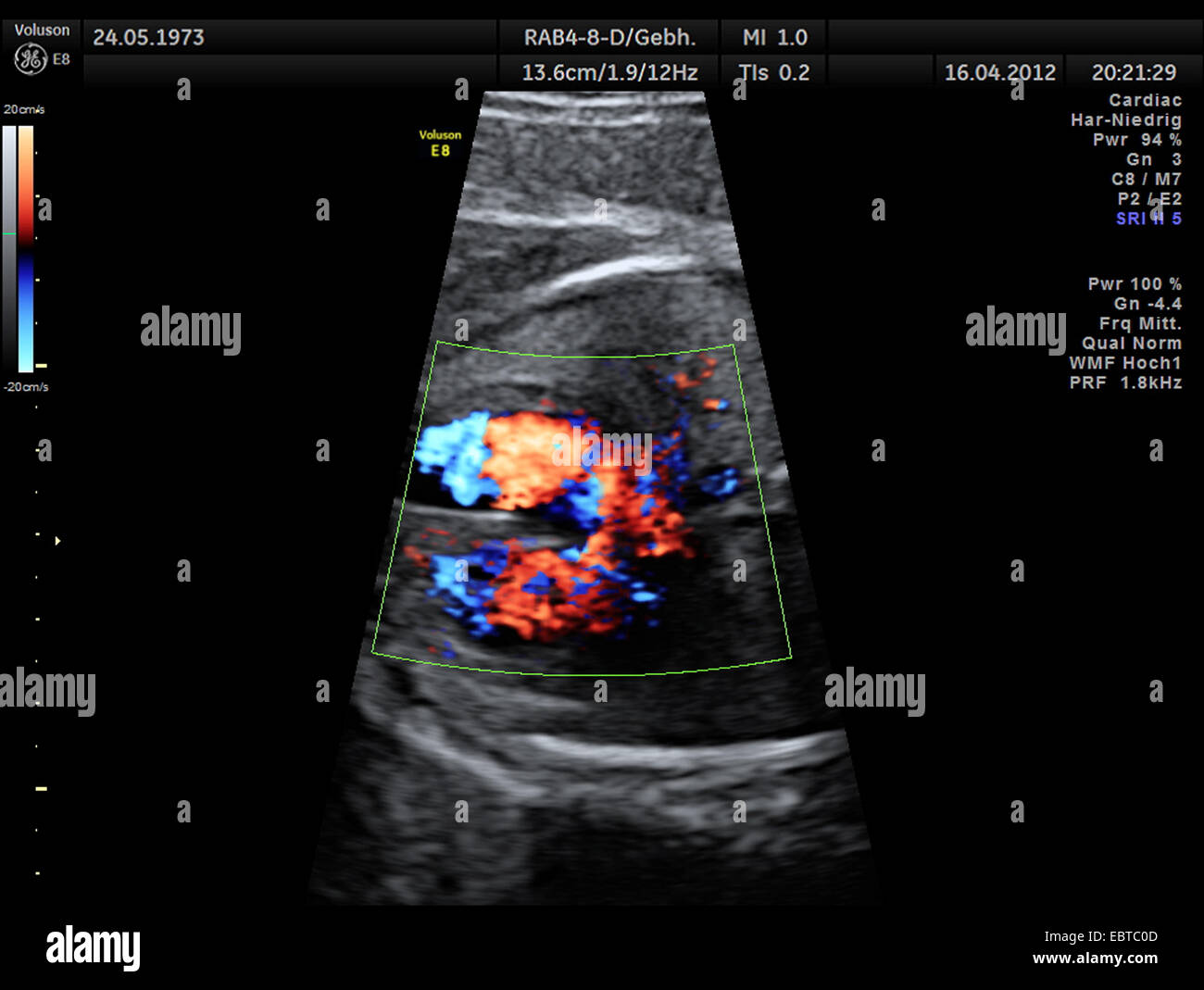 Sonogramme de la tête d'un embryon dans l'utérus avec schéma de ton coeur Banque D'Images