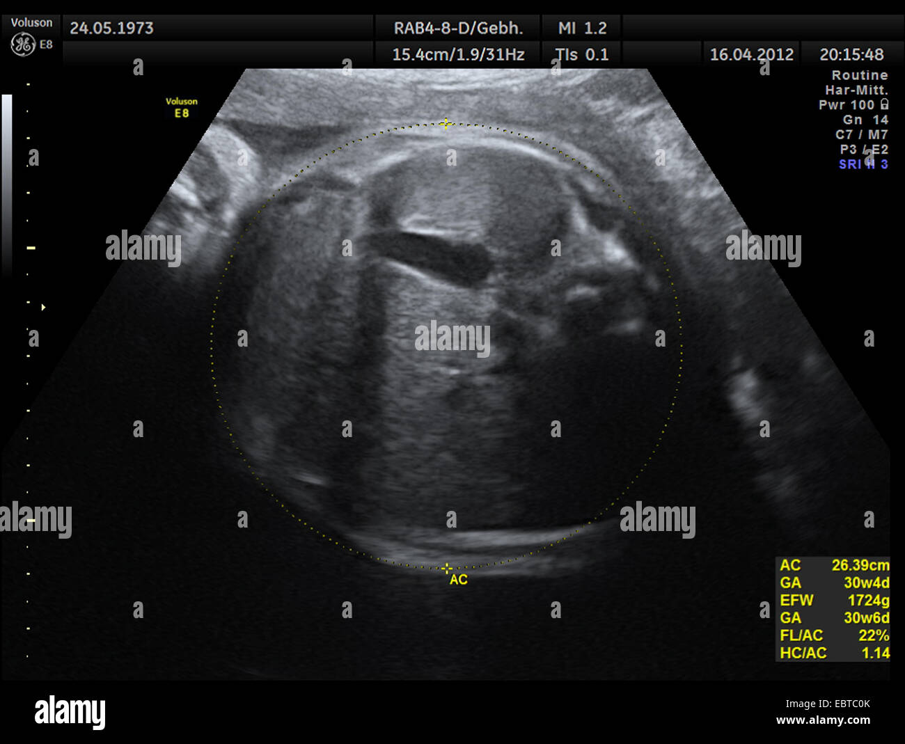 Sonogramme de l'embryon dans l'utérus Banque D'Images