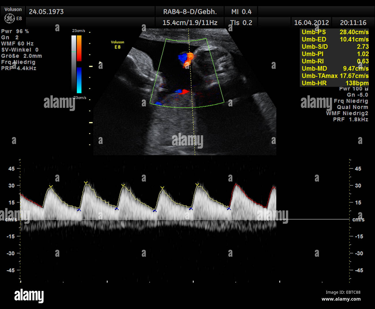 Sonogramme de l'embryon dans l'utérus avec schéma de ton coeur Banque D'Images