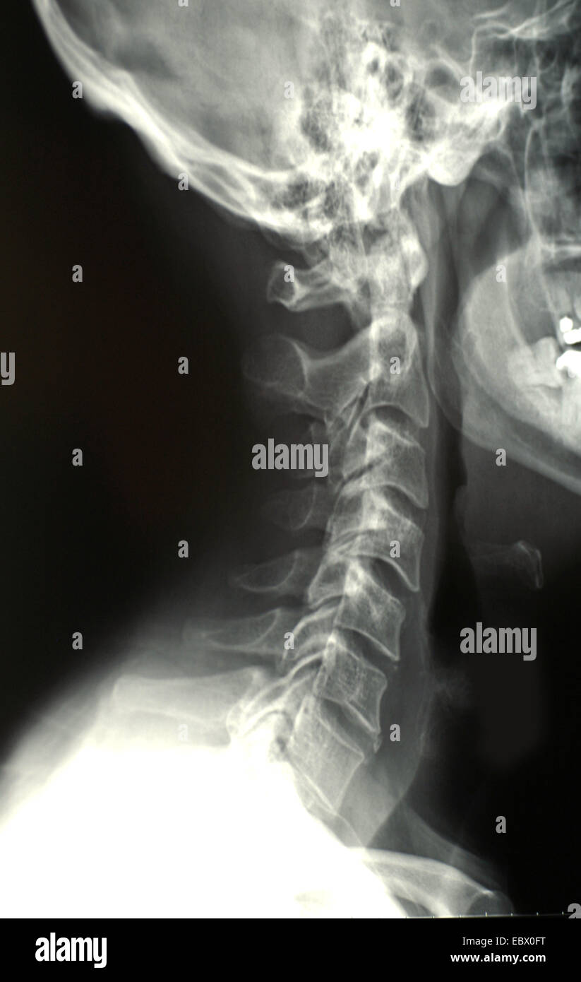 X-ray photo d'un backbone de cou Banque D'Images