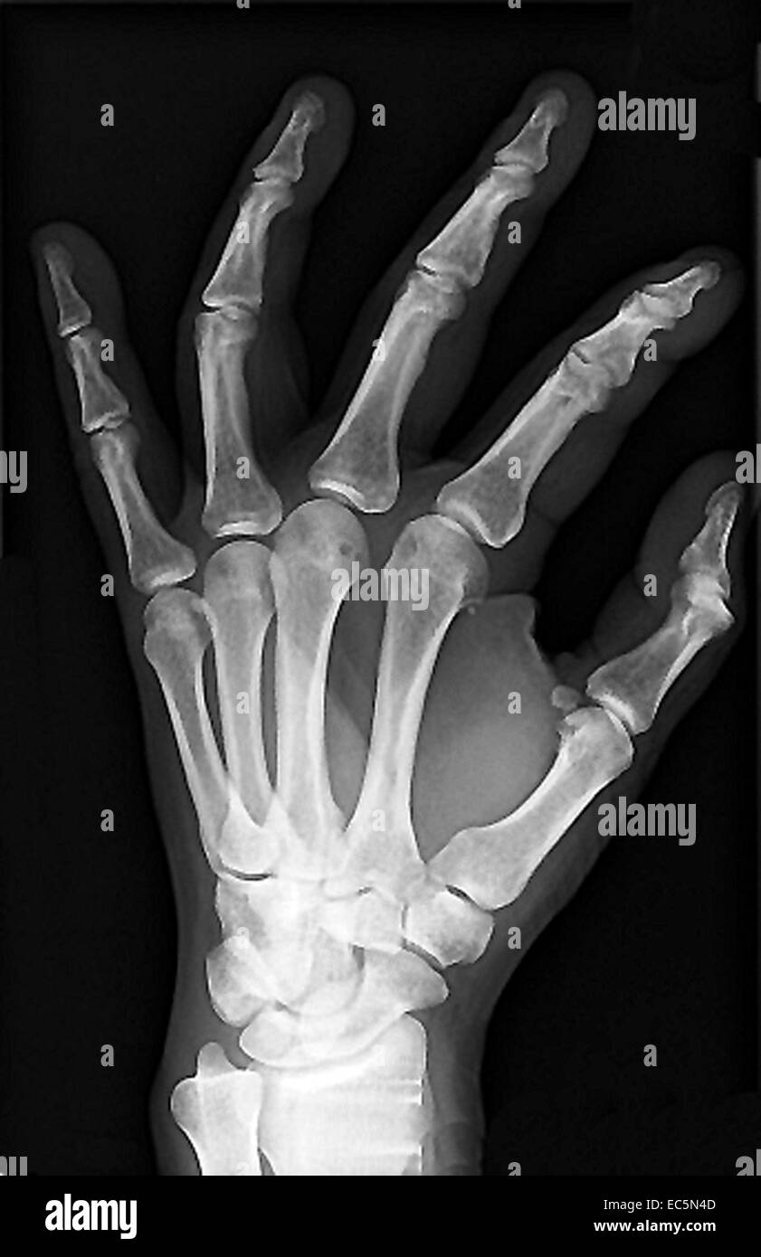 x-ray main Banque D'Images