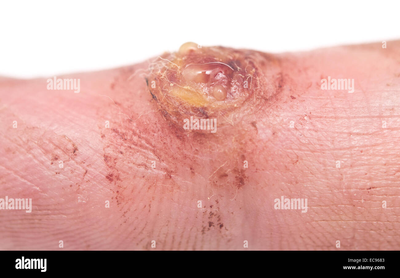 Close up de verrue sur la peau humaine Banque D'Images