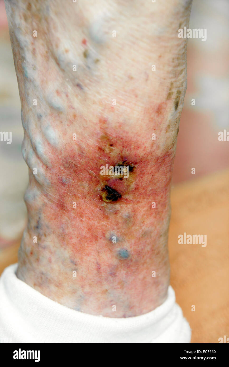 Ulcères variqueux situé sur une rupture de varice très douloureux et enflammés Banque D'Images