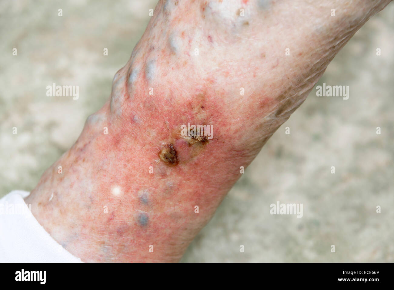 Ulcères variqueux situé sur une rupture de varice très douloureux et enflammés Banque D'Images