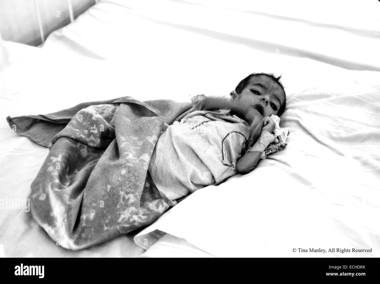 Malnutrition Et Deshydratation Bebe Dans L Alwya Hopital Pour Enfants A Bagdad Iraq Plus De Bebes Souffrent De Diarrhee Parce Que Le Traitement De L Eau A Ete Detruit Dans La Guerre Du Golfe