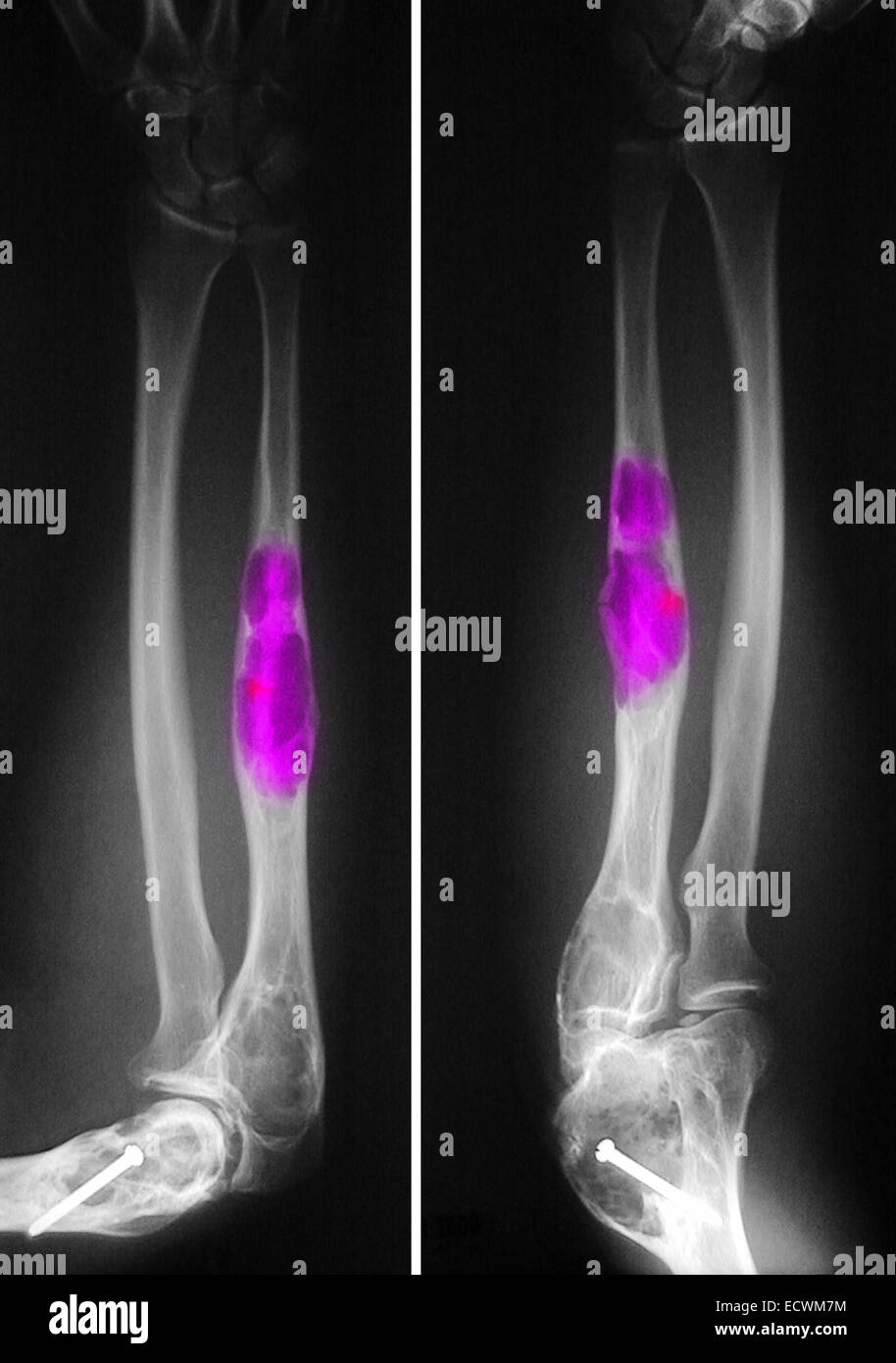 X-ray montrant dysplasie du cubitus et l'humérus. Banque D'Images