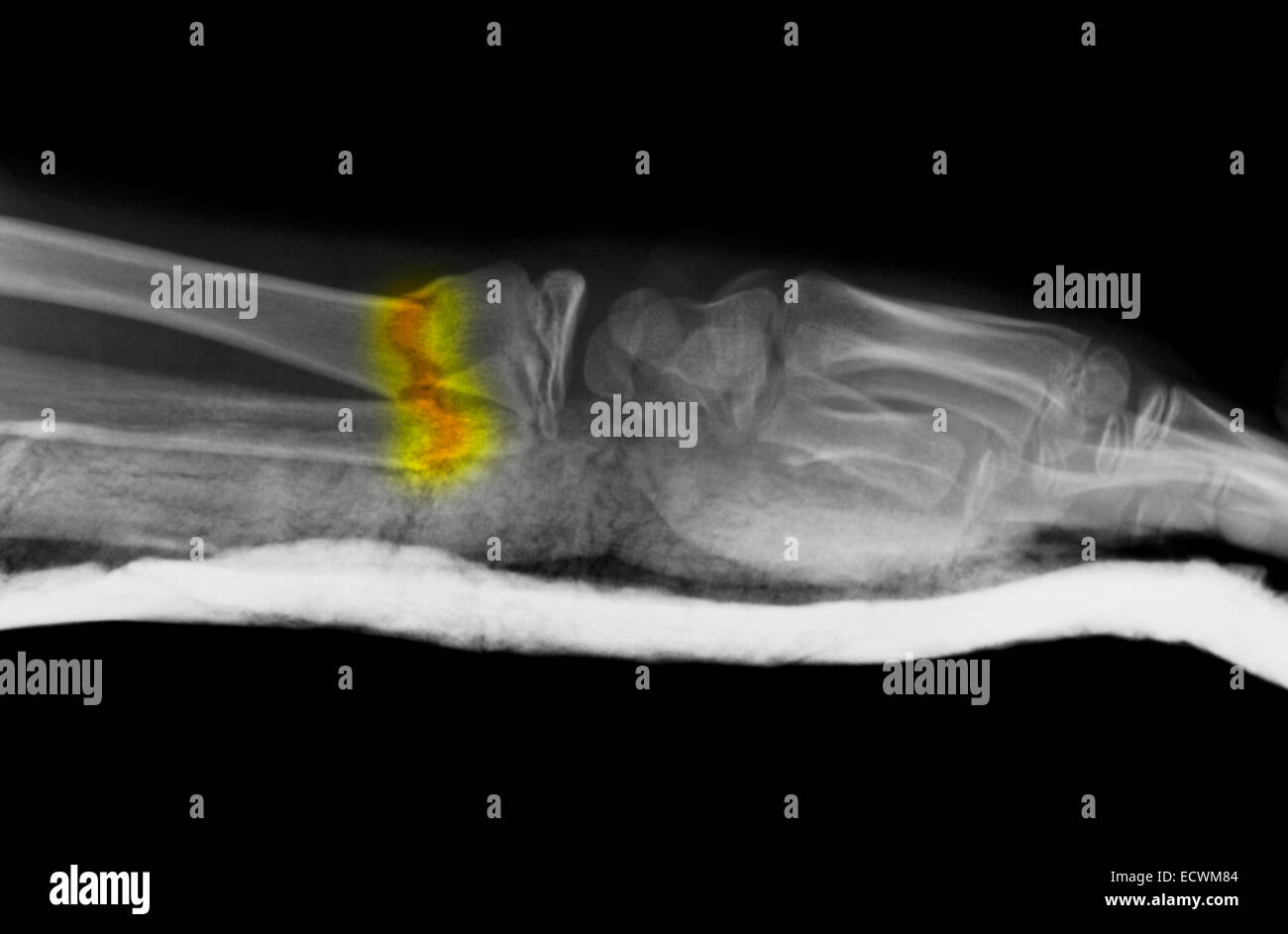 X-ray de l'avant-bras montrant une fracture. Banque D'Images