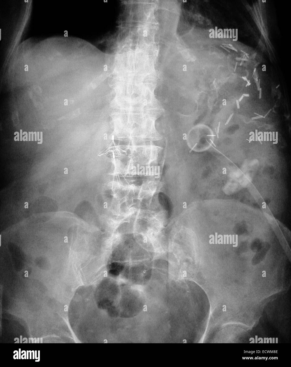 Abdomen x-ray montrant un caillot de sang dans la veine cave filtre. Banque D'Images