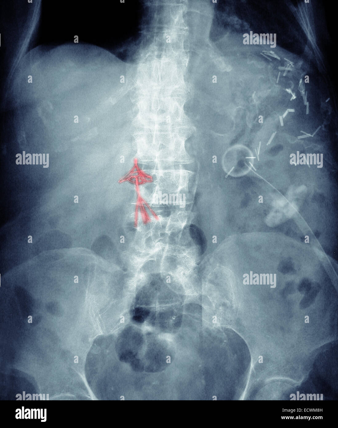 Abdomen x-ray montrant un caillot de sang dans la veine cave filtre. Banque D'Images