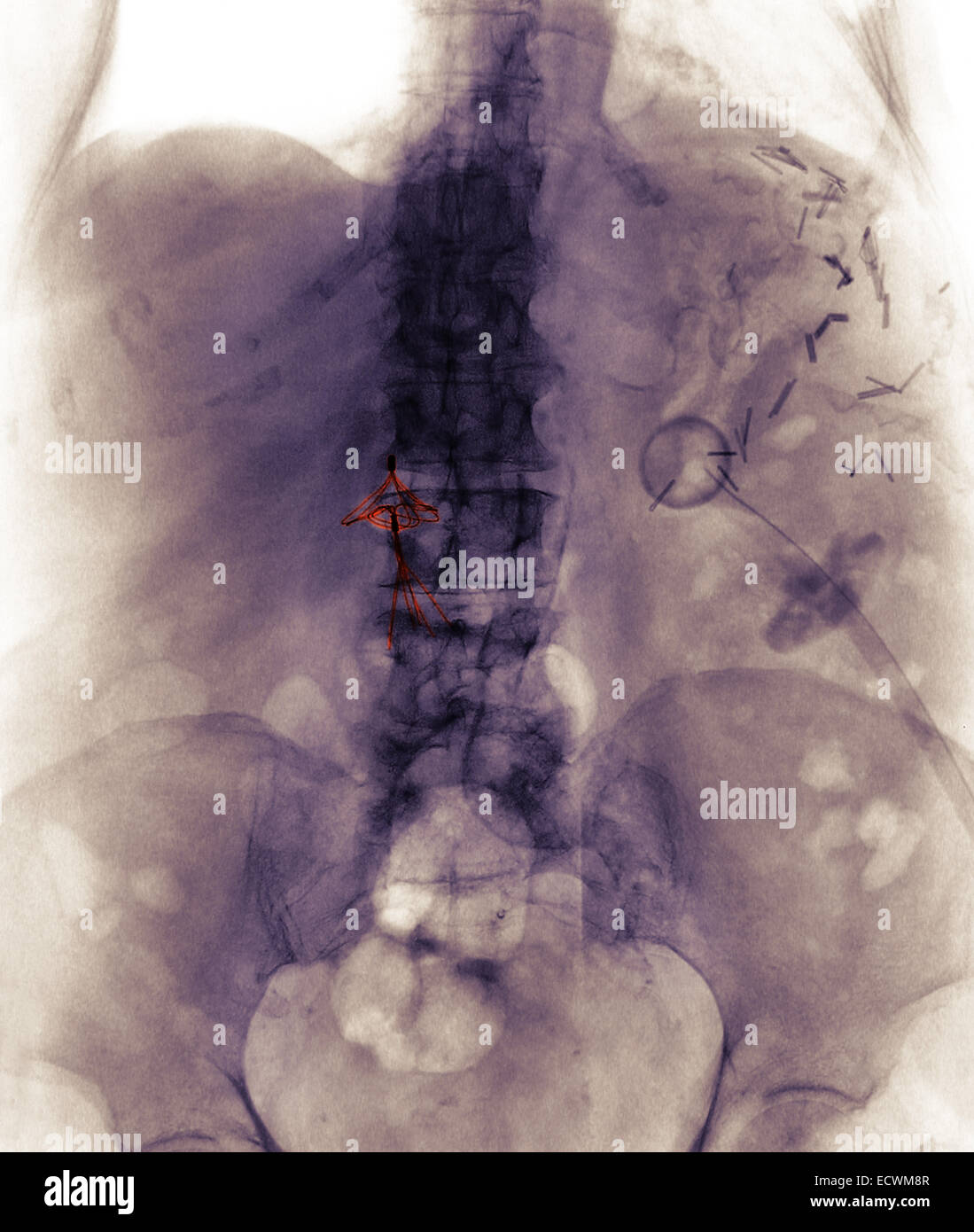 Abdomen x-ray montrant un caillot de sang dans la veine cave filtre. Banque D'Images