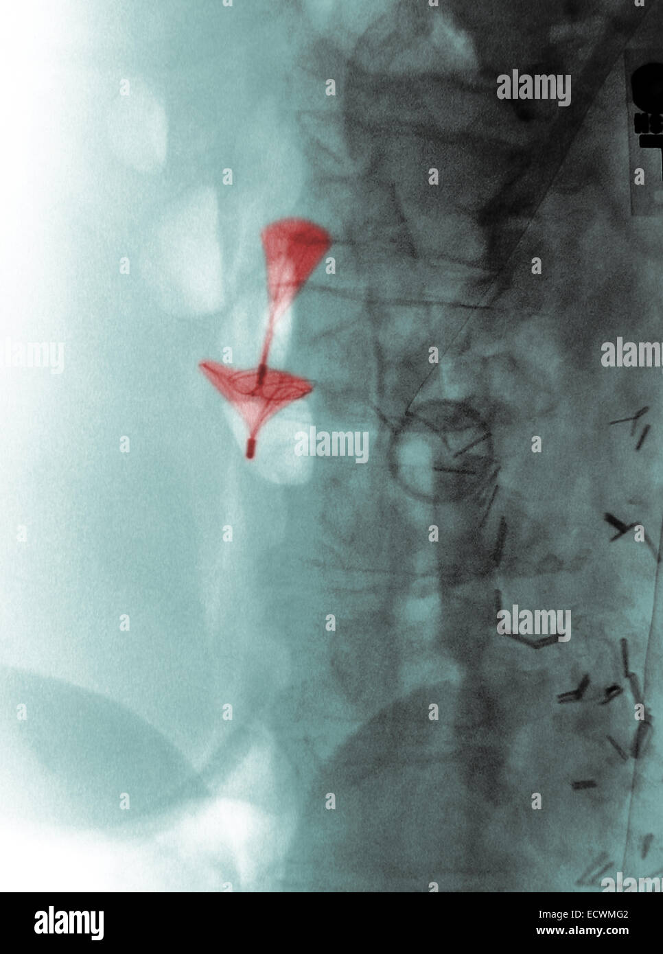 Abdomen x-ray montrant un caillot de sang dans la veine cave filtre. Banque D'Images