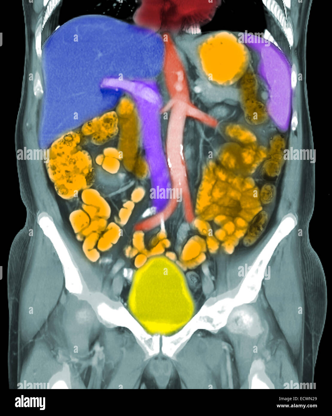 Les reconstructions coronale d'une tomodensitométrie de l'abdomen montrant cancer métastatique de la prostate. Banque D'Images