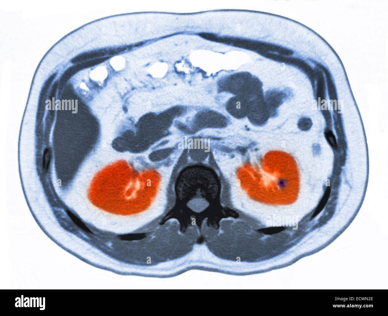 Ct scan abdomen Banque d'images détourées - Alamy