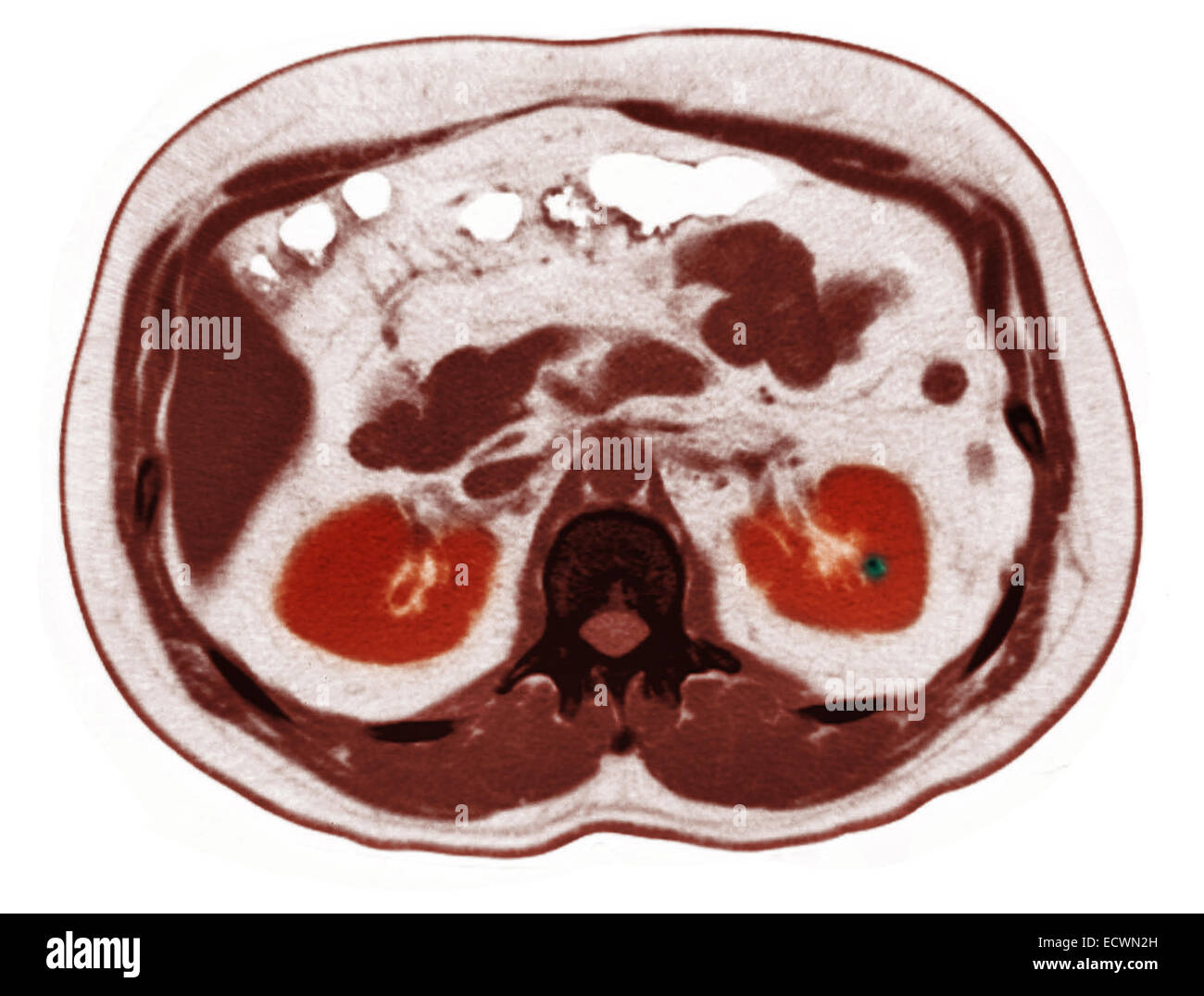 Scanographie de l'abdomen montrant un petit calcul rénal. Banque D'Images