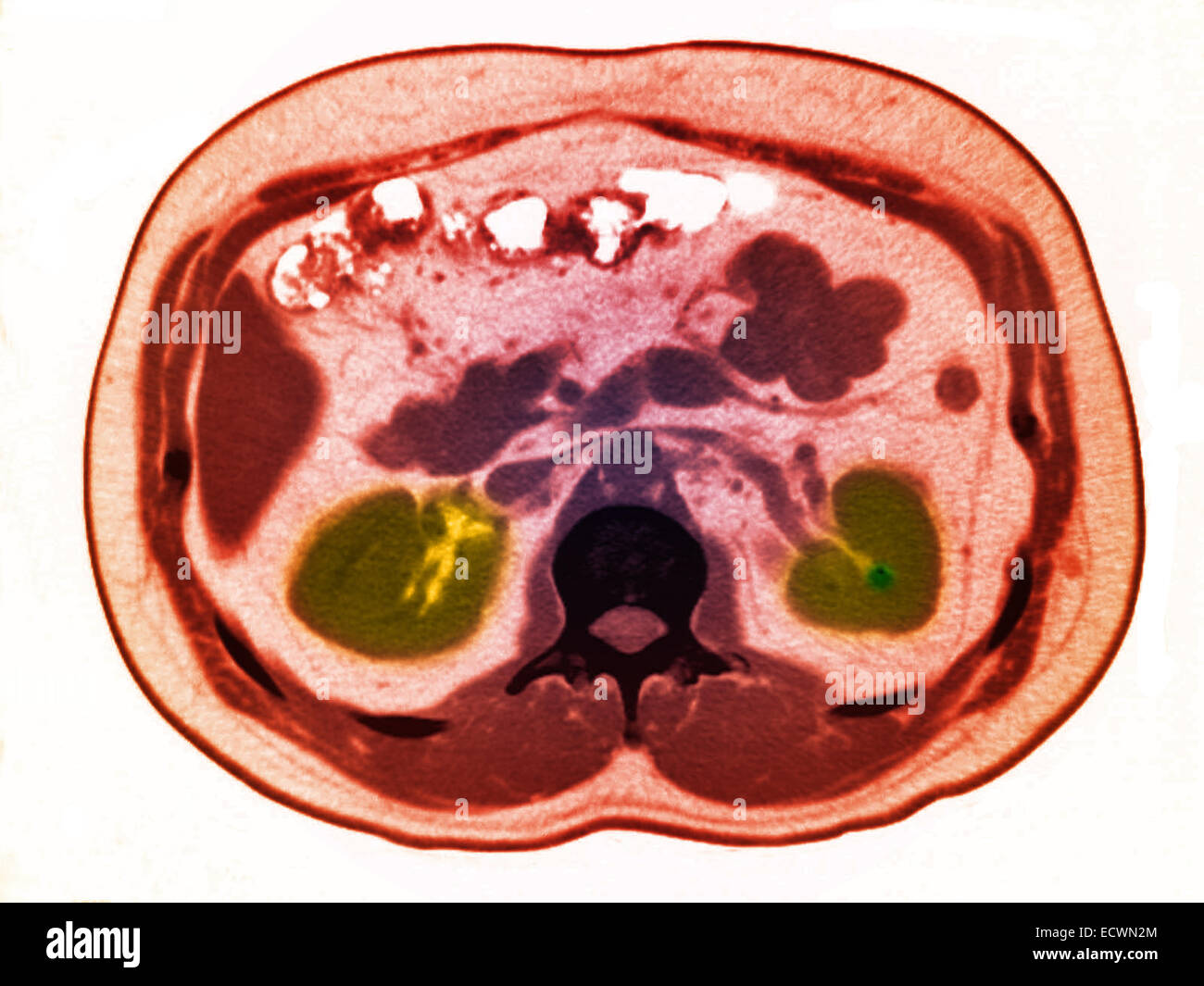 Ct scan abdomen Banque de photographies et d’images à haute résolution ...