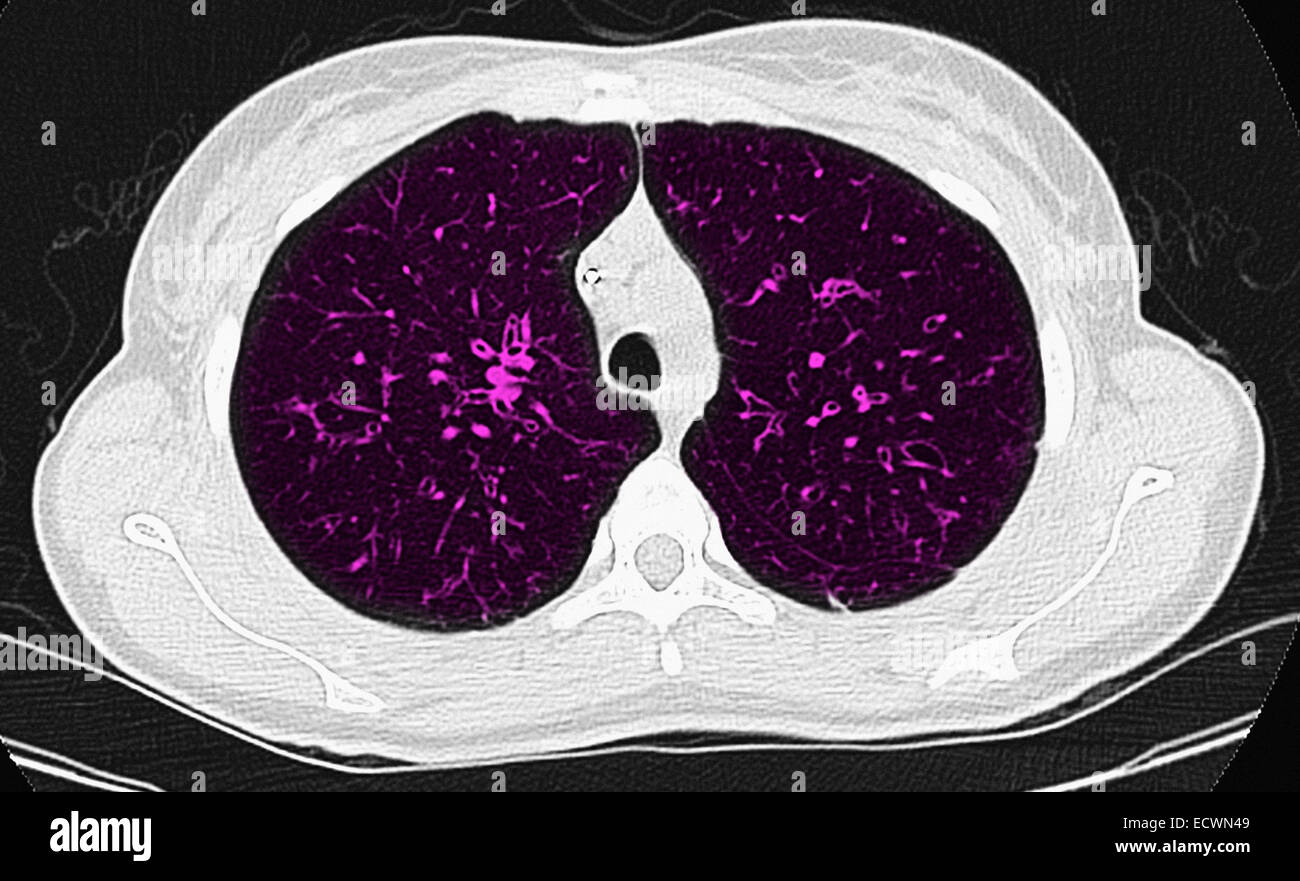 La fibrose kystique CT scan vue axiale. Banque D'Images