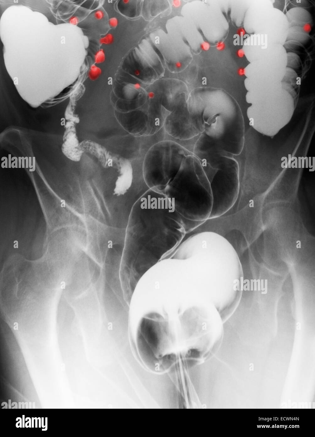 Abdomen x-ray montrant la diverticulose du côlon. Banque D'Images