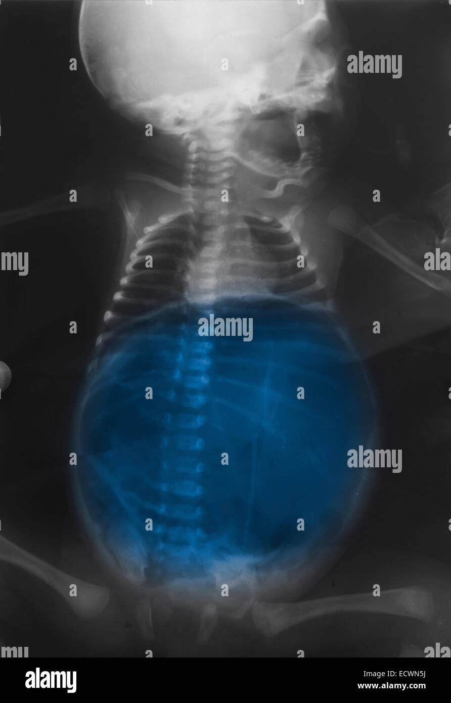 X-ray montrant une grande quantité de gaz dans l'abdomen. Banque D'Images