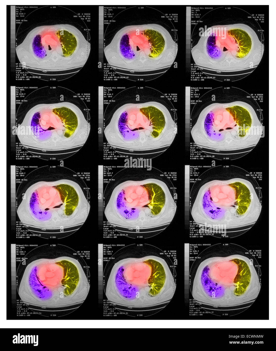 CT scan de la poitrine montrant une pneumonie. Banque D'Images