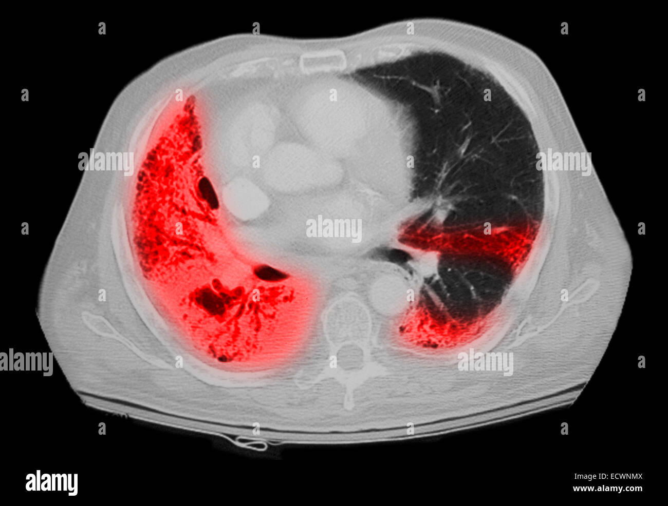 CT scan de la poitrine montrant une pneumonie. Banque D'Images