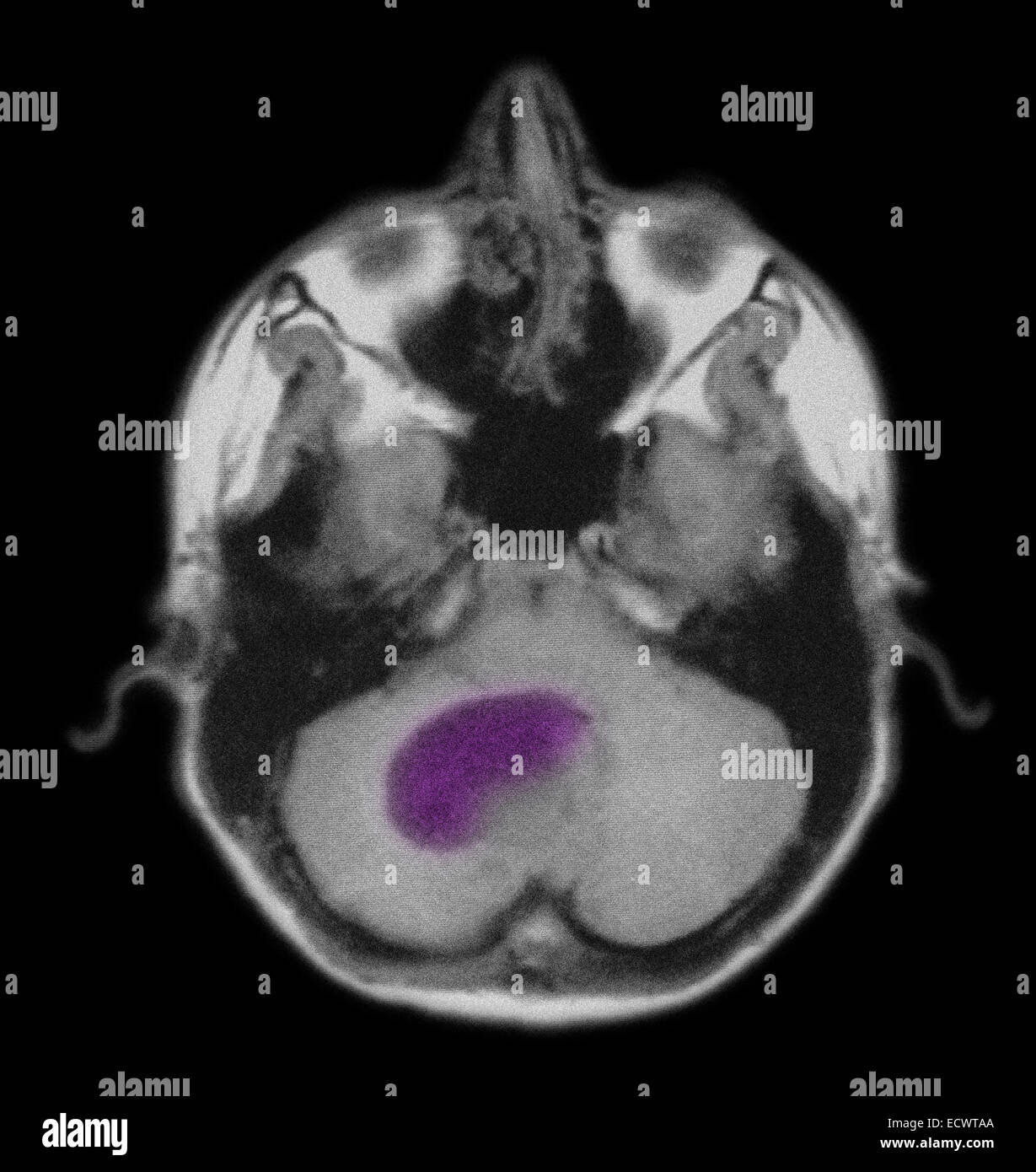 Pilocytic astrocytome du cerveau comme vu sur irm. Banque D'Images Pilocytic astrocytome du cerveau comme vu sur irm. Banque D'Images