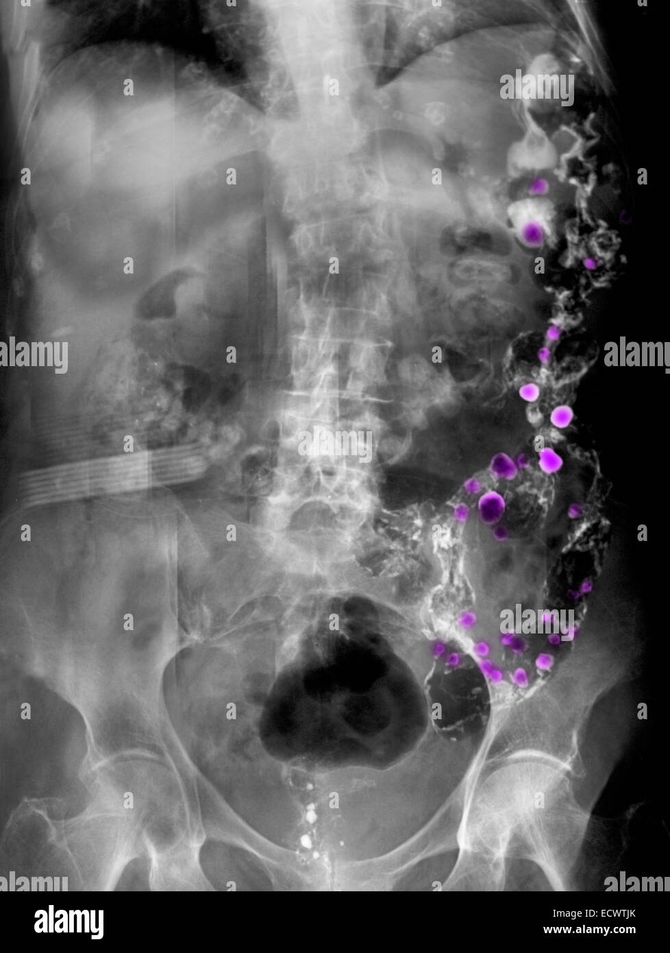 X-ray avec contraste baryté montrant la diverticulose. Banque D'Images