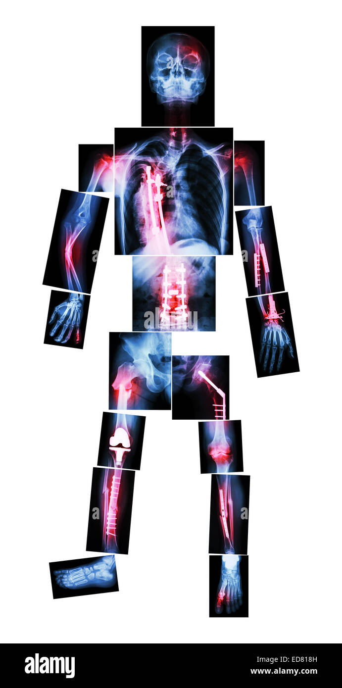 X-ray tout son corps et de multiples fractures. Il a été opéré et la fixation interne par vis et plaque Banque D'Images