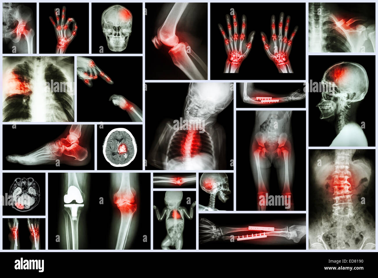 Collection X-ray des multiples d'organes et la chirurgie orthopédique et de multiples maladies (tuberculose pulmonaire , la goutte, l'arth Banque D'Images
