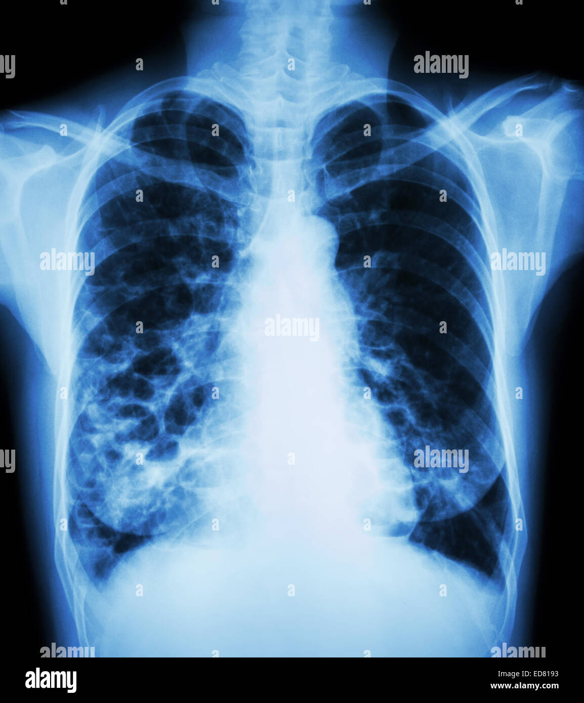 La Bronchiectasie' 'X-ray show : Poitrine de multiples kystes pulmonaires bleb et en raison de l'infection chronique Banque D'Images