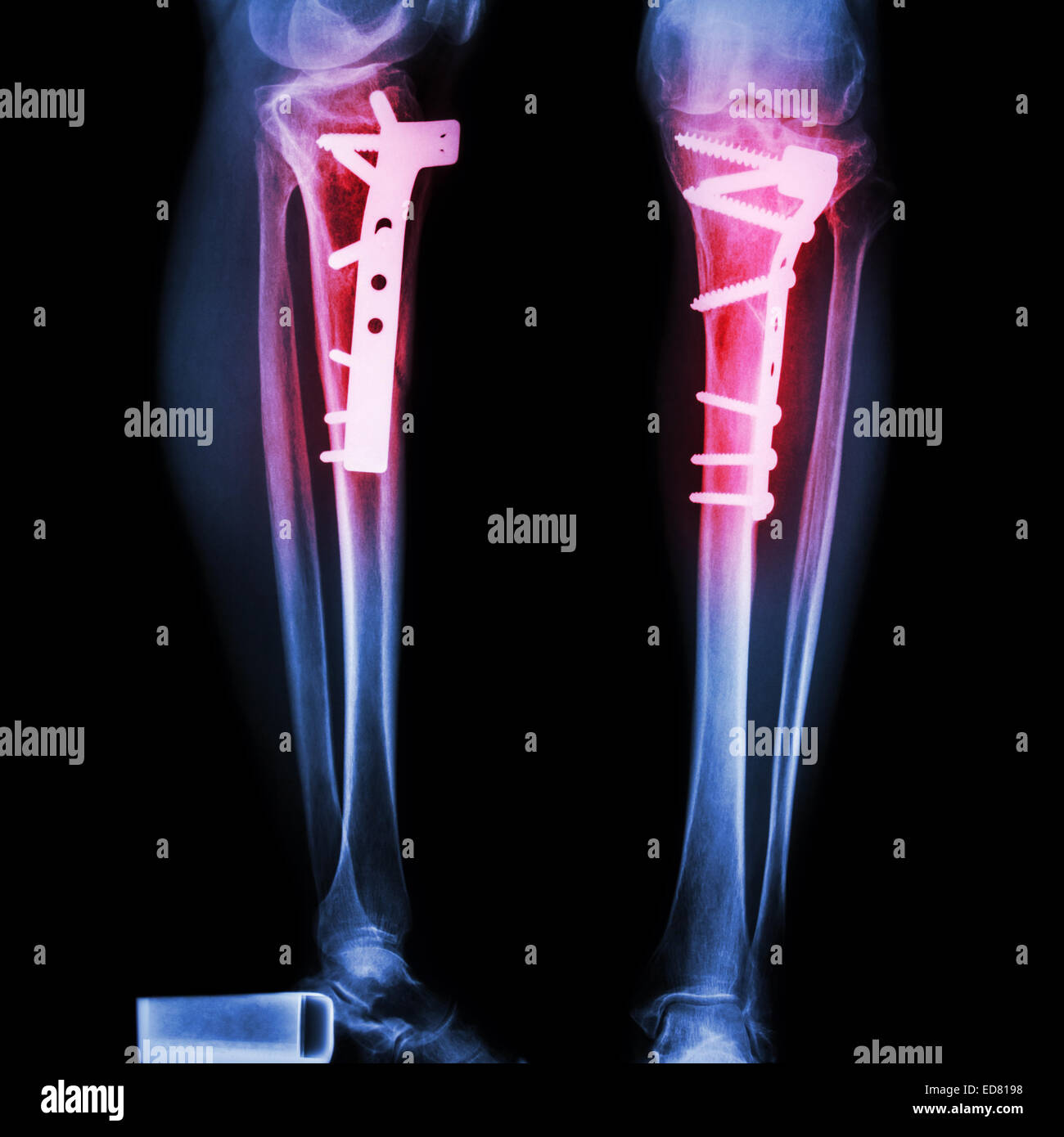 Tibia fracture de jambe(os). Il a été exploité et internes fixés par vis-plaque Banque D'Images