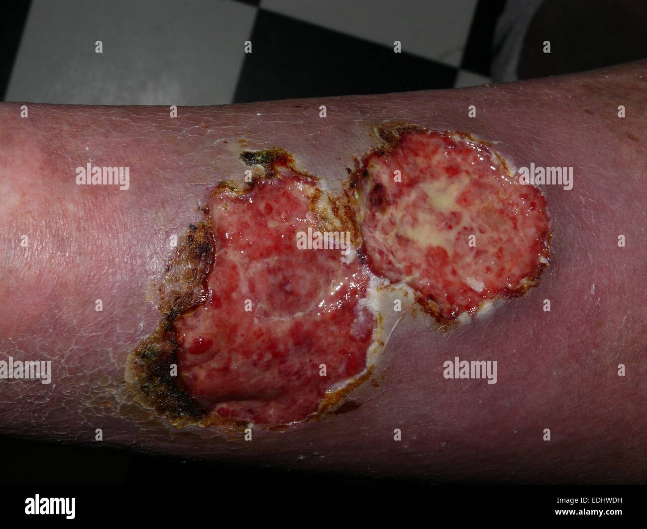Ulcères de jambe artérioveineuse avec super-infection et cancer Banque D'Images