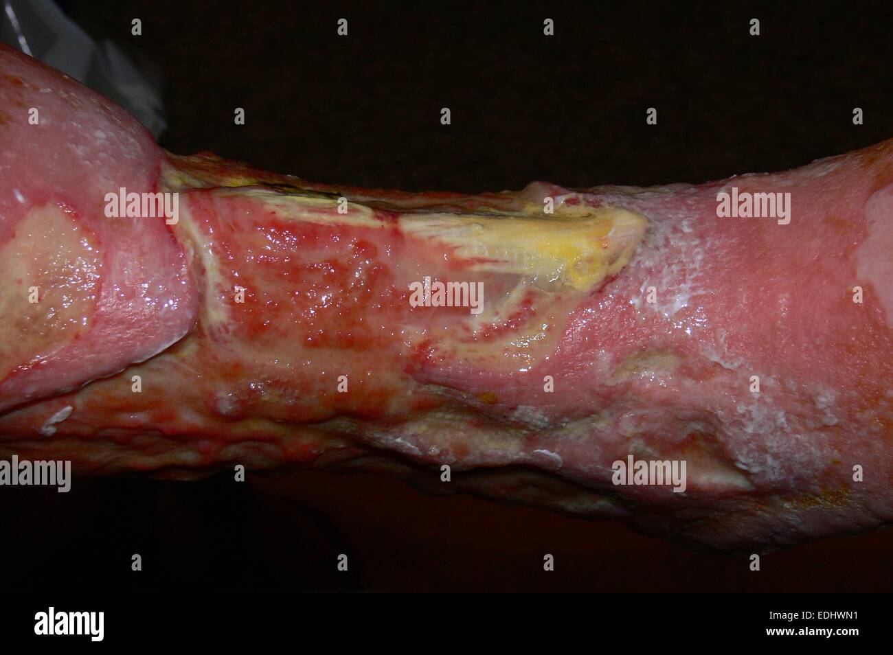 La jambe de 'Smoker (avec des cellules de type épidermoïde de la jambe Banque D'Images